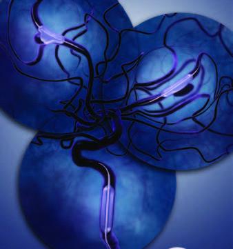 Balón de Oclusión Hyperglide y Hyperform